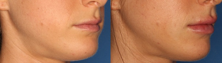 Lip Augmentation Before & After Gallery - Patient 24560977 - Image 1