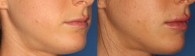 Lip Augmentation Gallery Before & After Gallery - Patient 24560977 - Image 1