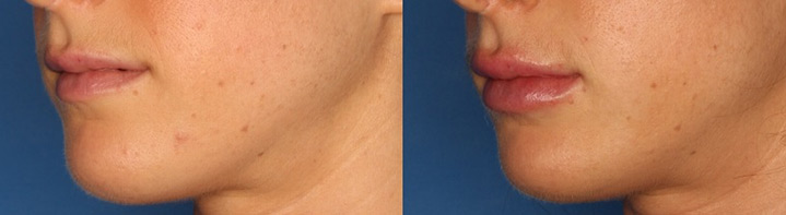 Lip Augmentation Gallery Before & After Gallery - Patient 24560977 - Image 2