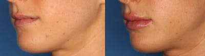 Lip Augmentation Gallery Before & After Gallery - Patient 24560977 - Image 2