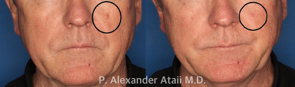 Mole Removal