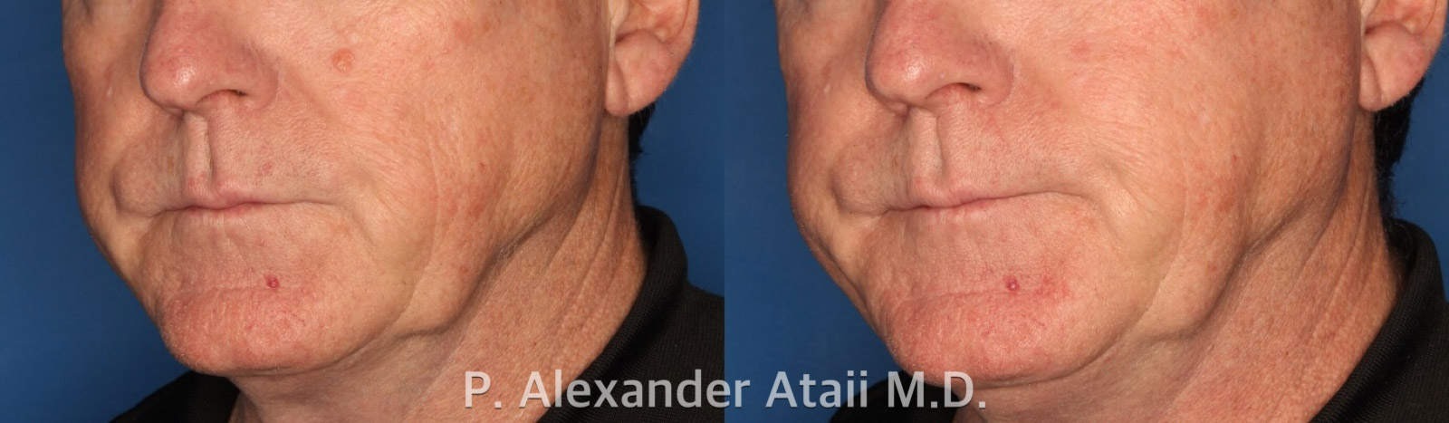 Mole Removal Before & After Gallery - Patient 24560978 - Image 2