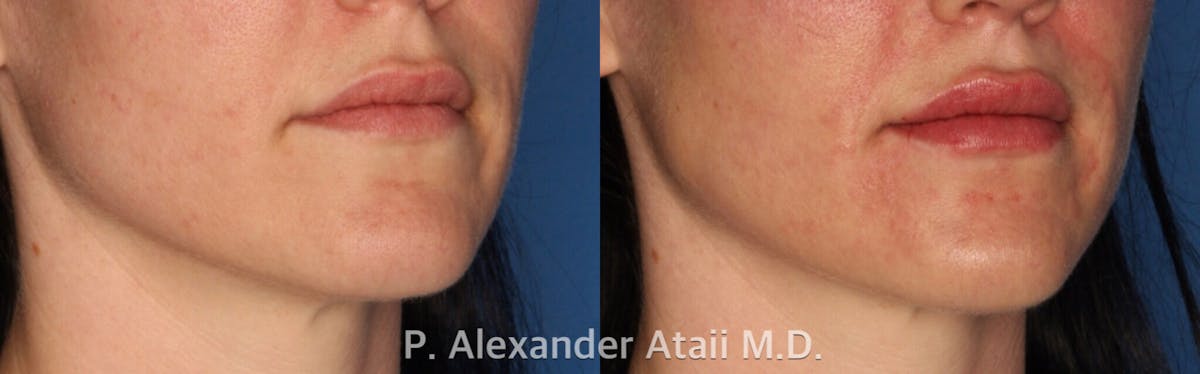 Lip Augmentation Gallery Before & After Gallery - Patient 24560981 - Image 1