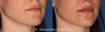 Lip Augmentation Gallery Before & After Gallery - Patient 24560981 - Image 1