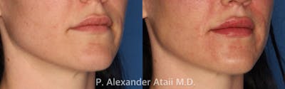 Lip Fillers Before & After Gallery - Patient 24560981 - Image 1