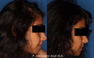 Before and After PRP for Hair Loss Patient 1