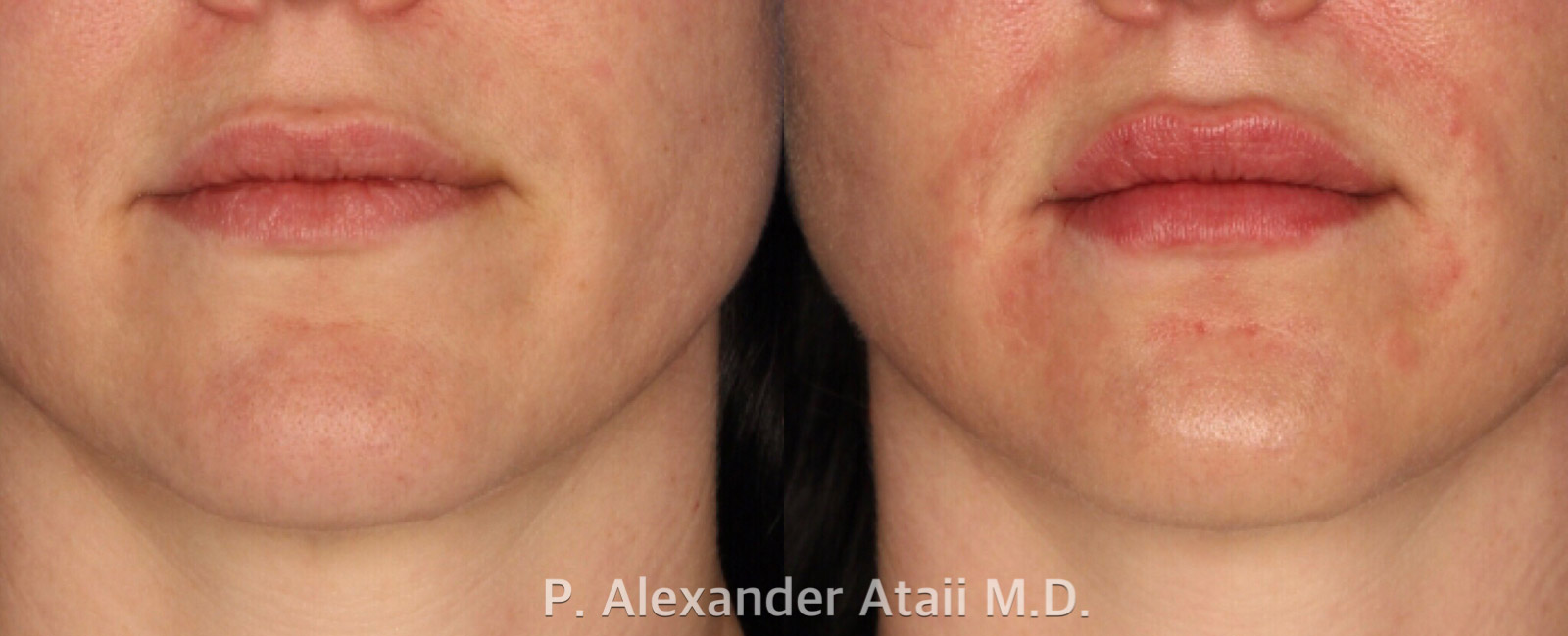 Lip Augmentation Before & After Gallery - Patient 24560981 - Image 2