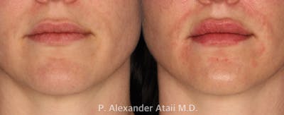 Lip Augmentation Gallery Before & After Gallery - Patient 24560981 - Image 2