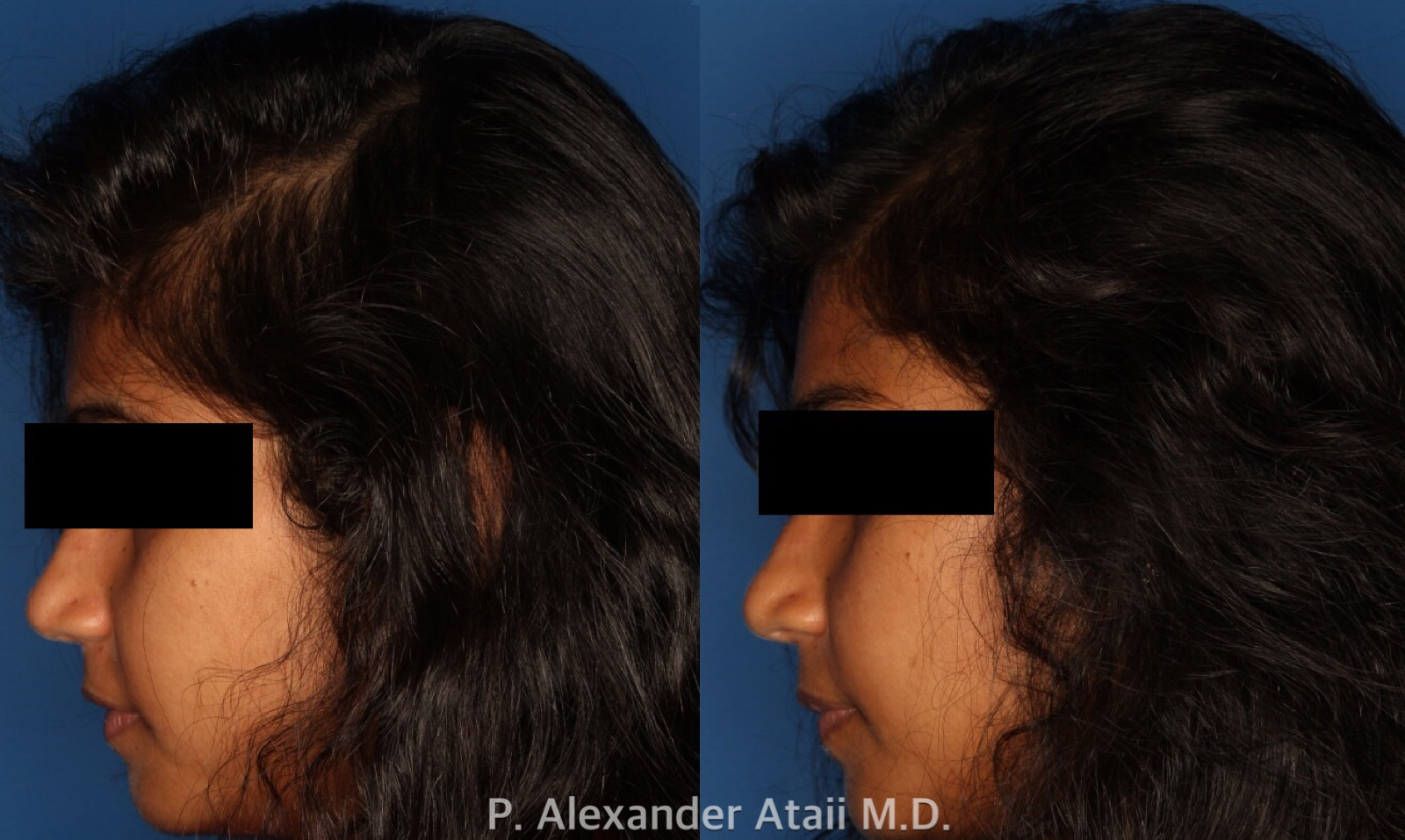 PRP Hair Loss Before & After Gallery - Patient 24560980 - Image 2