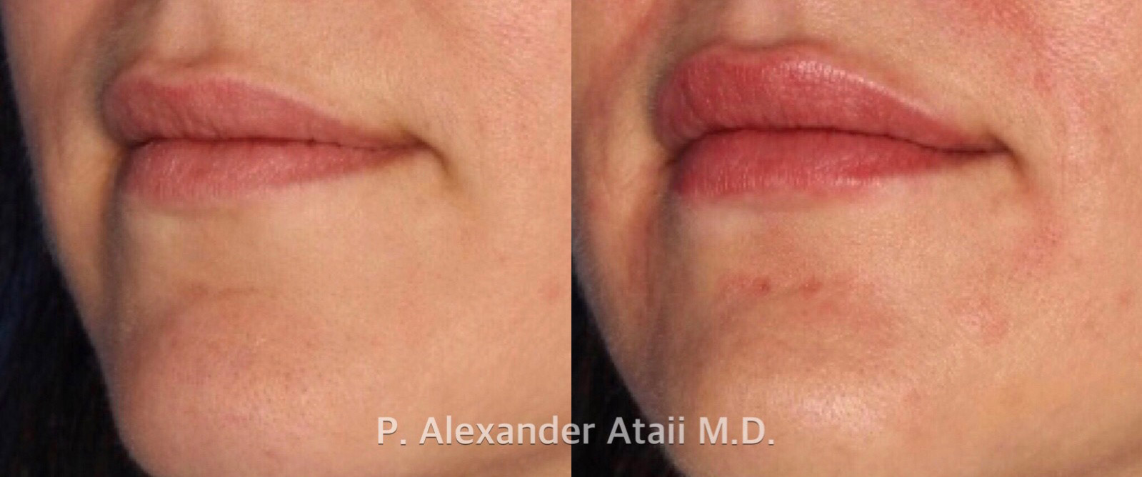 Lip Augmentation Gallery Before & After Gallery - Patient 24560981 - Image 3