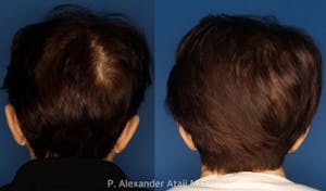 Before and After PRP for Hair Loss Patient 2