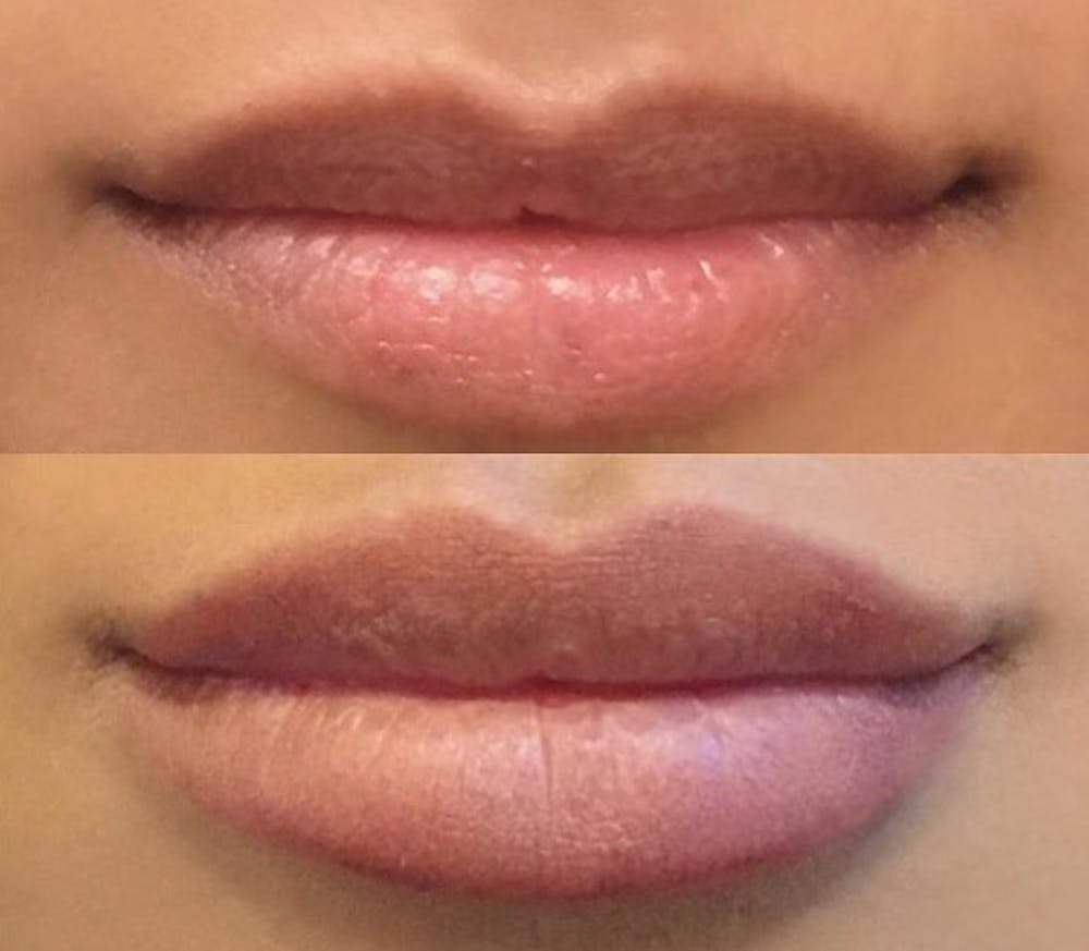 Lip Augmentation Before & After Gallery - Patient 24560983 - Image 1