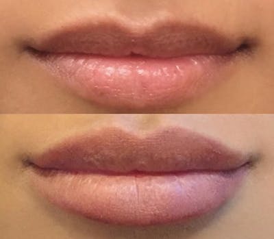 Lip Fillers Before & After Gallery - Patient 24560983 - Image 1