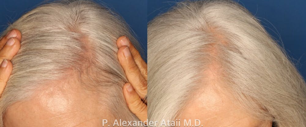Before and After PRP for Hair Loss Patient 3