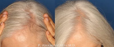 PRP Hair Loss Gallery - Patient 24560985 - Image 1