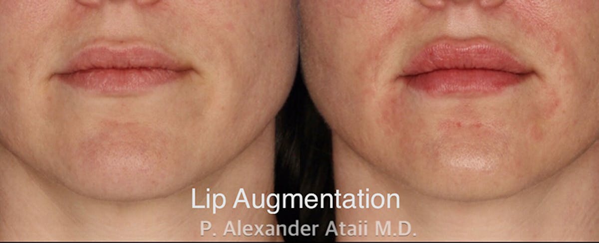 Lip Augmentation Gallery Before & After Gallery - Patient 24560984 - Image 1