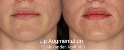 Lip Augmentation Gallery Before & After Gallery - Patient 24560984 - Image 1
