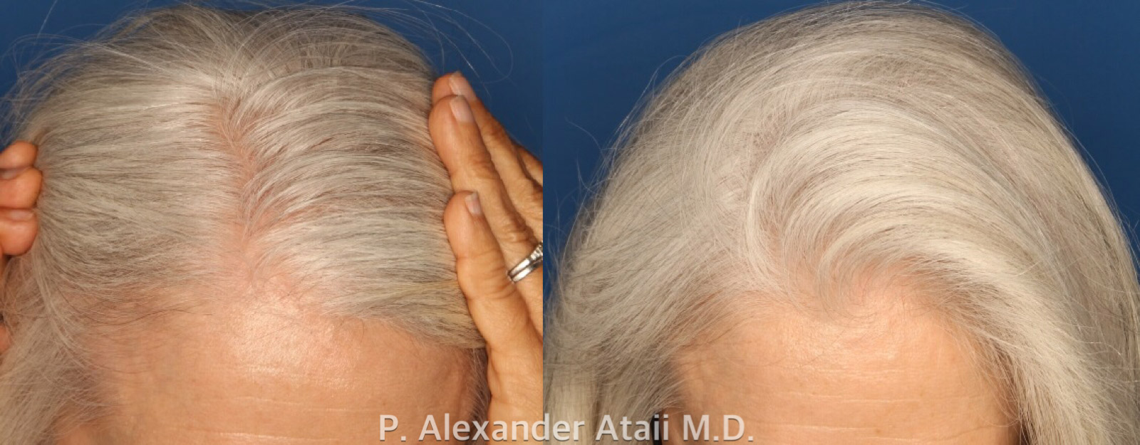 PRP Hair Loss Before & After Gallery - Patient 24560985 - Image 2