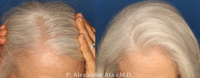 PRP Hair Loss Gallery Before & After Gallery - Patient 24560985 - Image 2