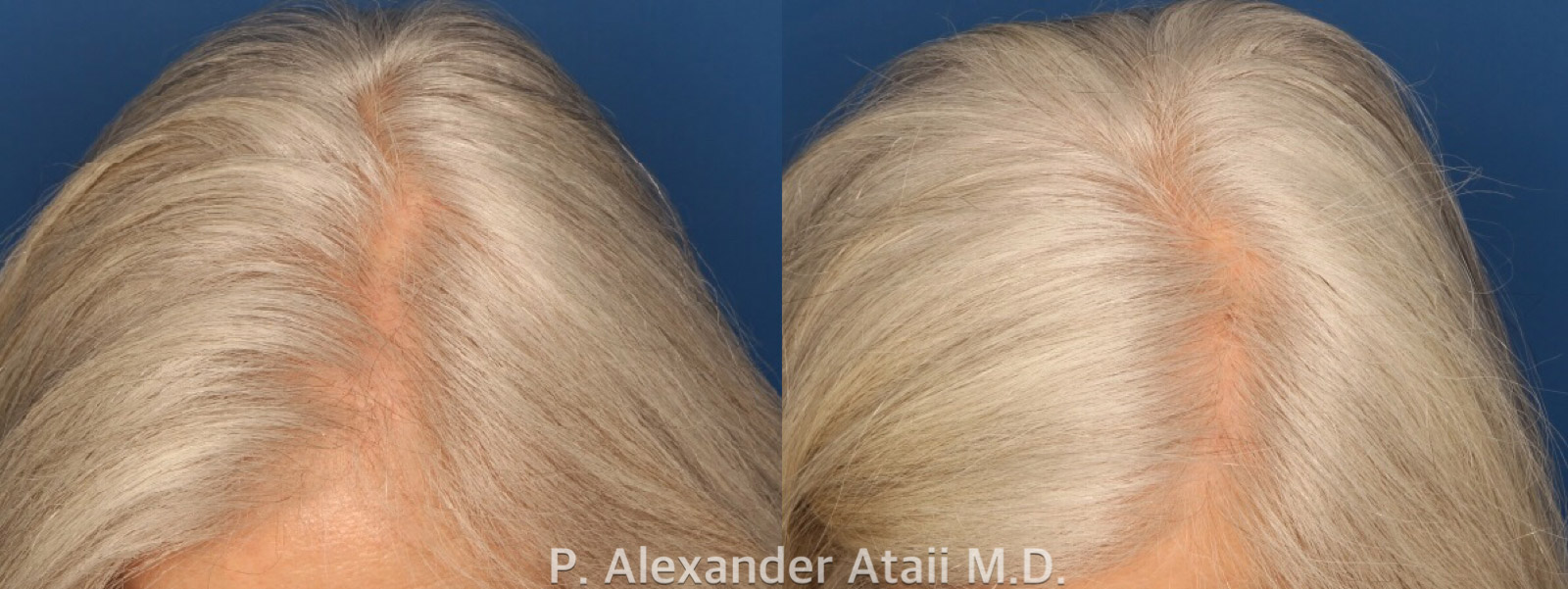 PRP Hair Loss Gallery Before & After Gallery - Patient 24560985 - Image 3