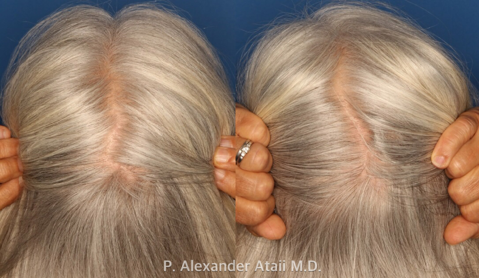 PRP Hair Loss Before & After Gallery - Patient 24560985 - Image 4