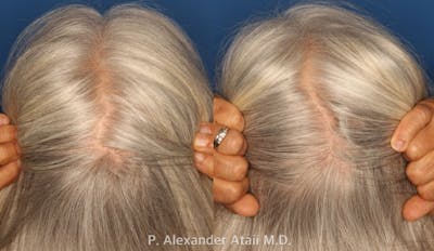 PRP Hair Loss Gallery Before & After Gallery - Patient 24560985 - Image 4