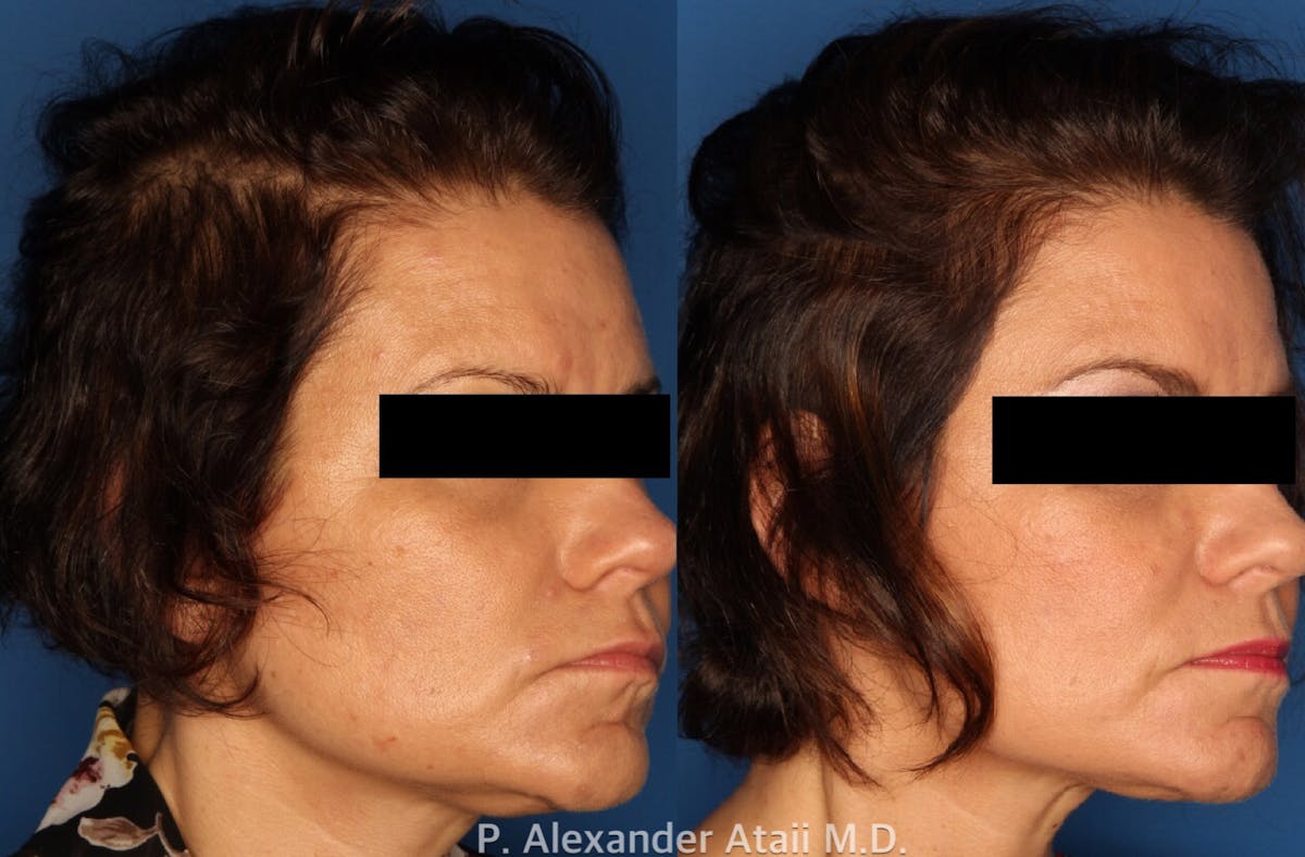 PRP Hair Loss Before & After Gallery - Patient 24560986 - Image 1
