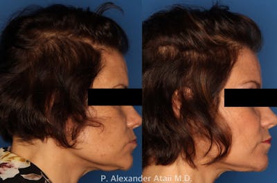 PRP Hair Loss Gallery Before & After Gallery - Patient 24560986 - Image 2