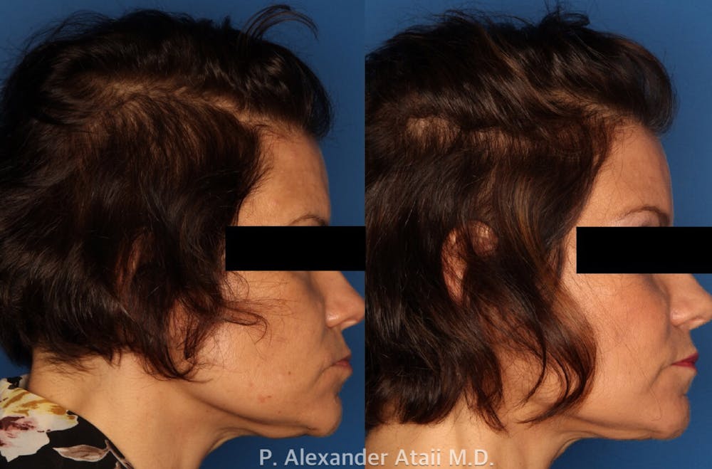 PRP Hair Loss Before & After Gallery - Patient 24560986 - Image 2