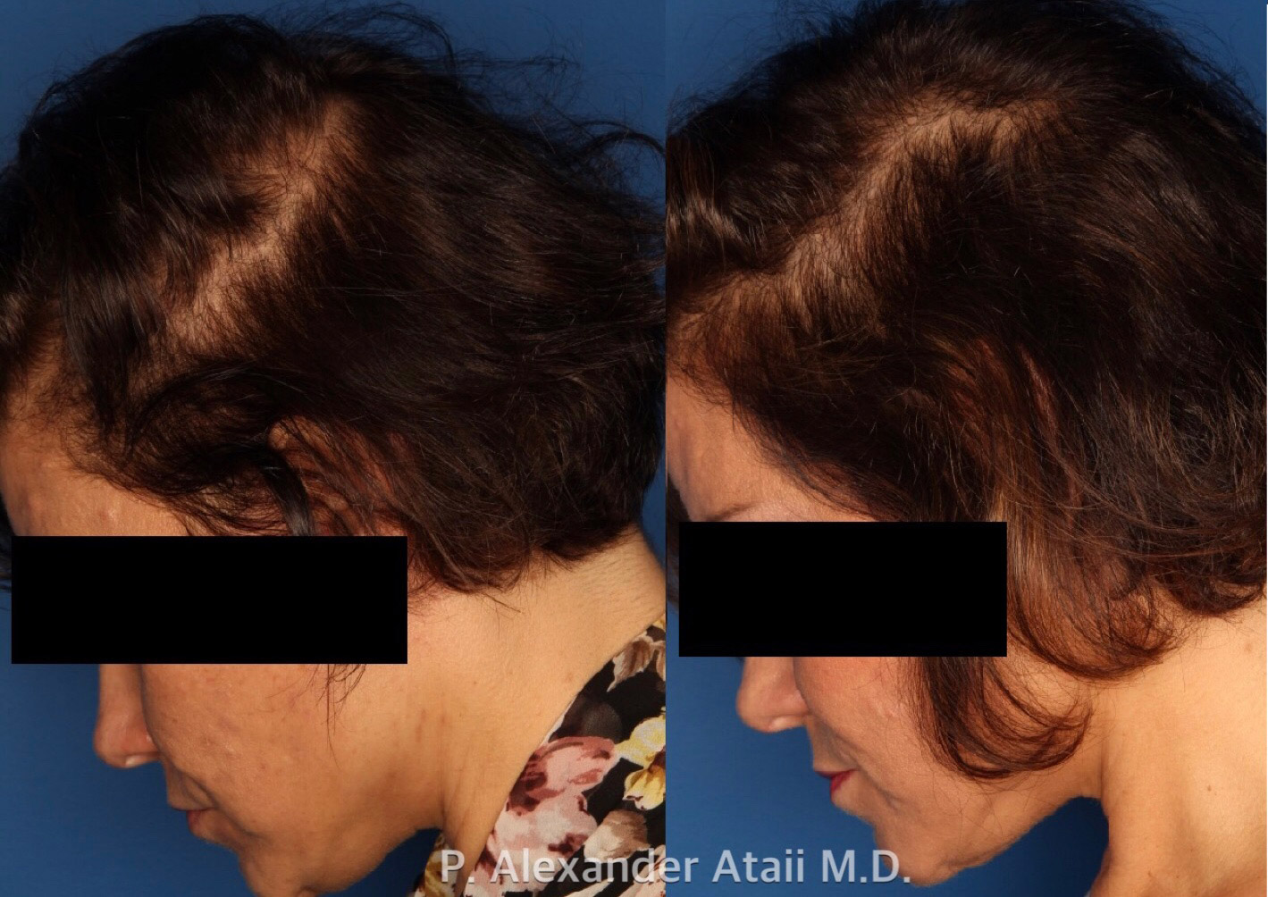 PRP Hair Loss Before & After Gallery - Patient 24560986 - Image 3