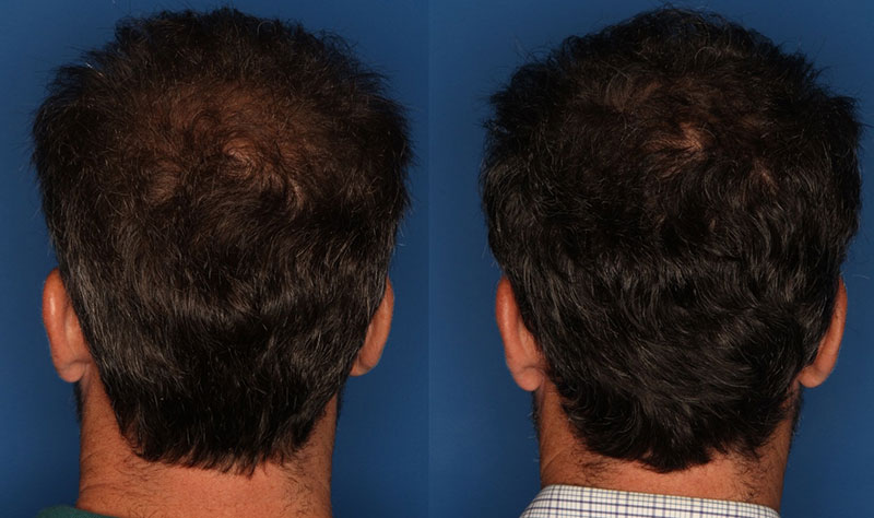 PRP Hair Loss Before & After Gallery - Patient 24560990 - Image 1