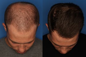 PRP for Male Hair Loss