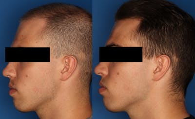 PRP Hair Loss Gallery Before & After Gallery - Patient 24560991 - Image 2