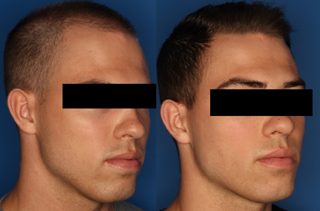 PRP Hair Loss Before & After Gallery - Patient 24560991 - Image 3