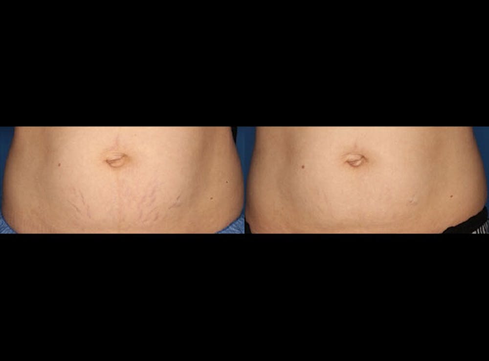 Stretch Marks