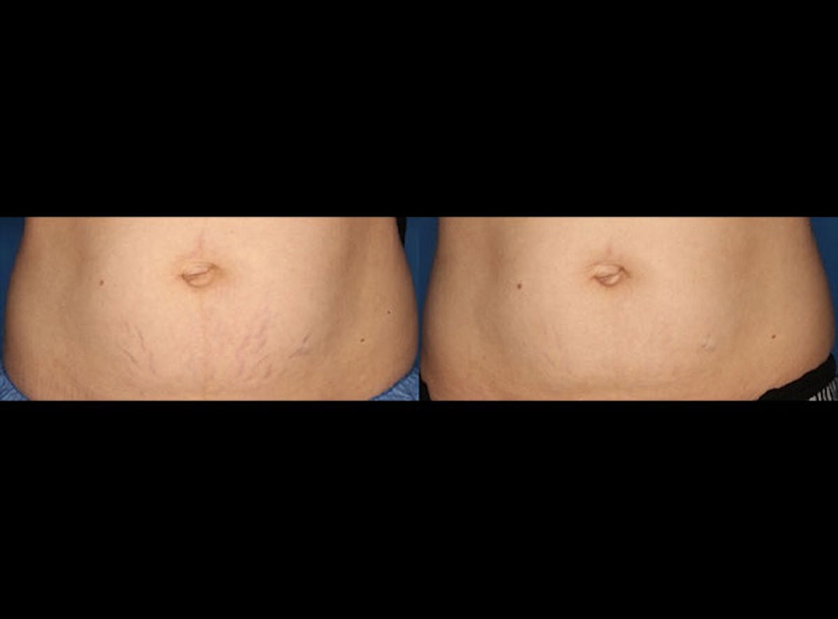Stretch Mark Removal Before & After Gallery - Patient 24560992 - Image 1