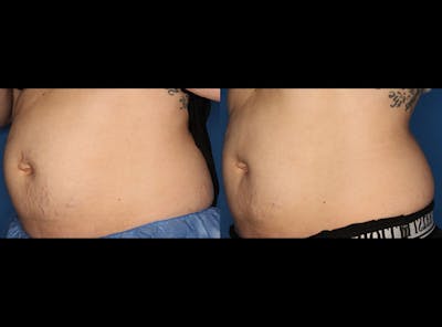 Stretch Mark Removal Before & After Gallery - Patient 24560992 - Image 2