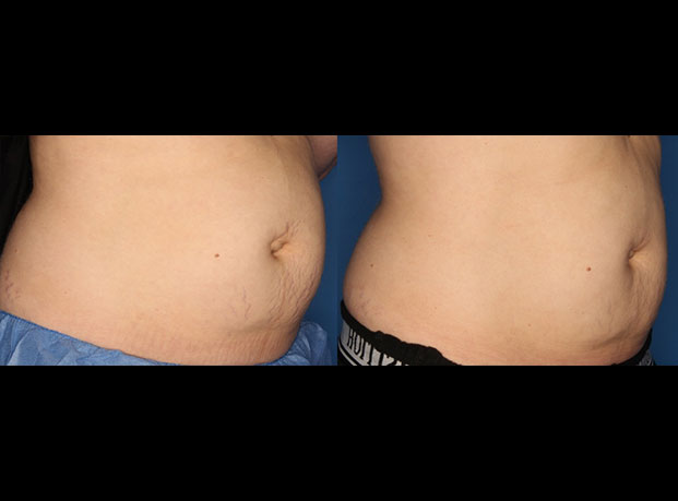 Stretch Mark Removal Gallery Before & After Gallery - Patient 24560992 - Image 3