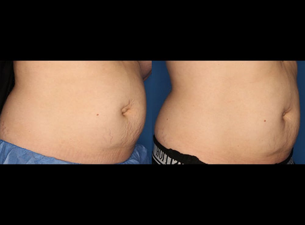 Stretch Mark Removal Before & After Gallery - Patient 24560992 - Image 3