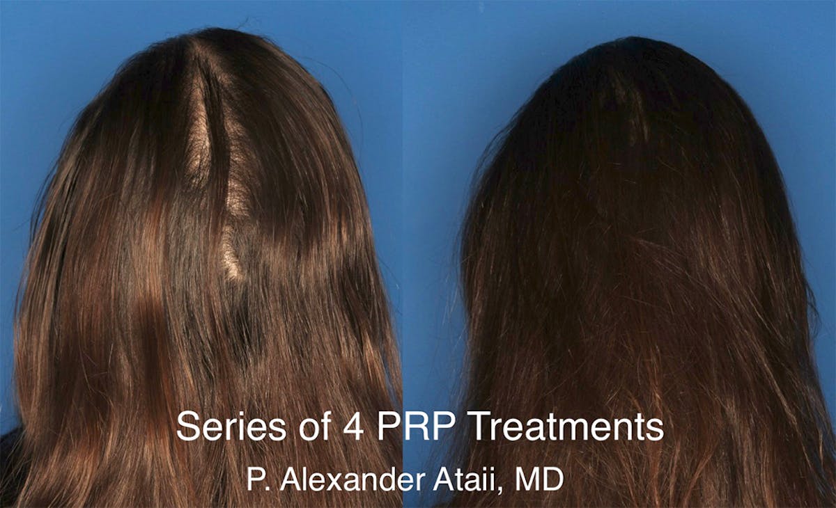 PRP Hair Loss Gallery Before & After Gallery - Patient 24560993 - Image 1