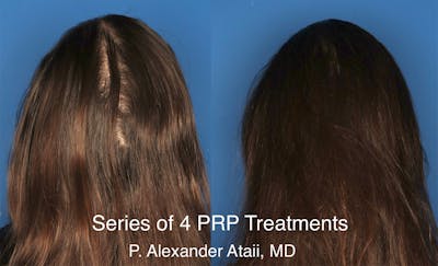 PRP Hair Loss Gallery - Patient 24560993 - Image 1