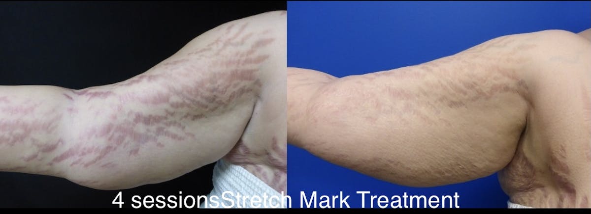Stretch Mark Removal Before & After Gallery - Patient 24560994 - Image 1