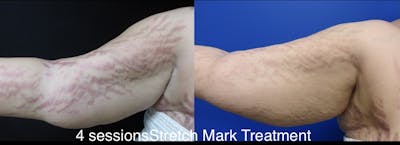 Stretch Mark Removal Gallery - Patient 24560994 - Image 1
