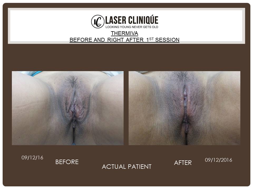 Before and After Vaginal Rejuvenation