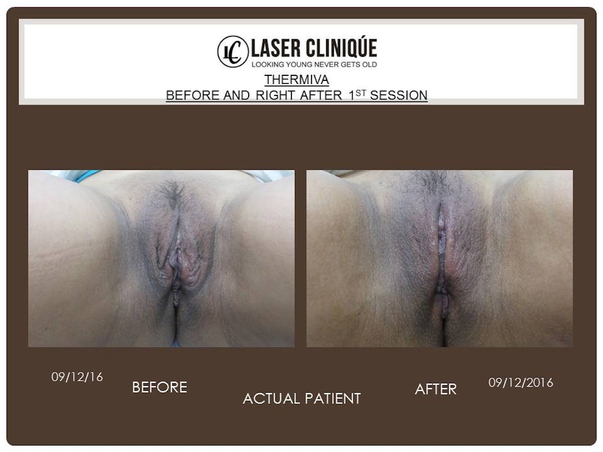 Before and After Vaginal Rejuvenation