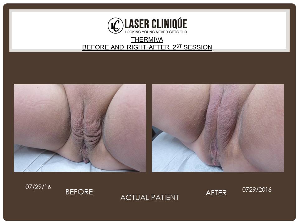 ThermiVa Gallery Before & After Gallery - Patient 24560998 - Image 1