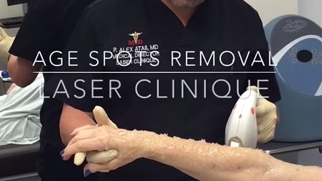 Age Spots Removal