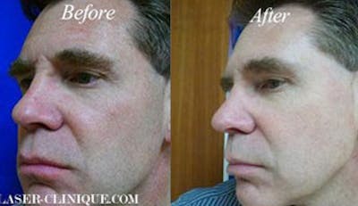 LaserFirm Before & After Gallery - Patient 24560547 - Image 1