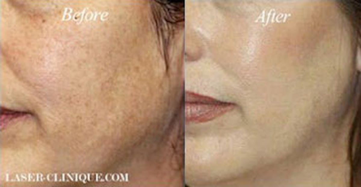 LaserFirm Gallery Before & After Gallery - Patient 24560549 - Image 1