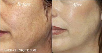LaserFirm Before & After Gallery - Patient 24560549 - Image 1